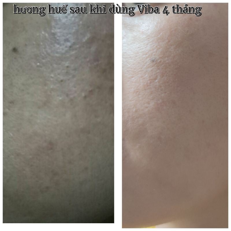 ( Chăm sóc cấp ẩm da) Xịt khoáng tươi Viba cấp ẩm, kiềm dầu, se khít lỗ chân lông, chống lão hoá | BigBuy360 - bigbuy360.vn
