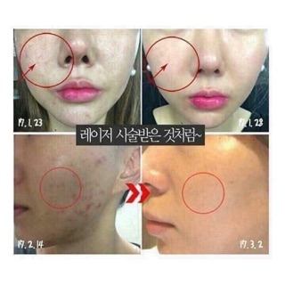 [Mẫu Thử] Bộ Dưỡng Dành Cho Da Mụn I'MeLe