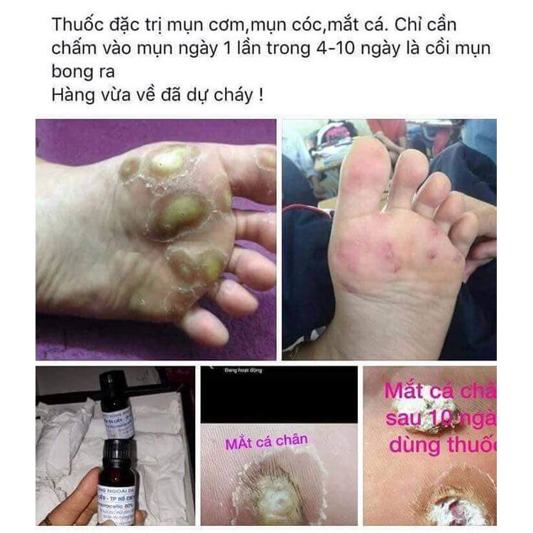 Ãxit Acid 80%( đánh bay mụn cóc,cơm..). | BigBuy360 - bigbuy360.vn