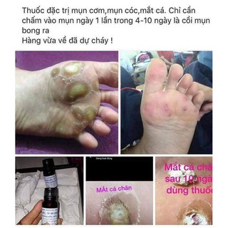 Ãxit Acid 80%( đánh bay mụn cóc,cơm..).