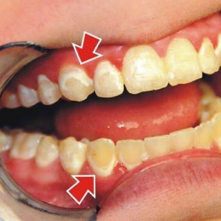 Máy tẩy trắng răng luma