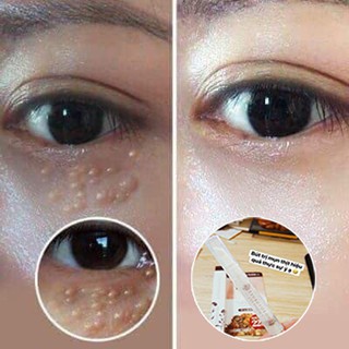 Gel Trị Mụn Thịt Mắt Tsubuporon