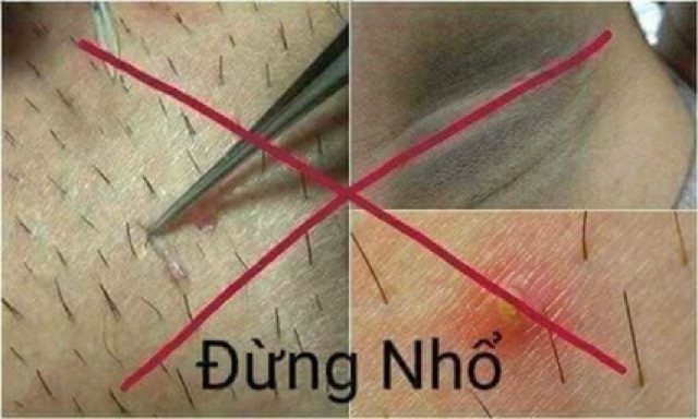 Combo Wax veo triệt lông vĩnh viễn