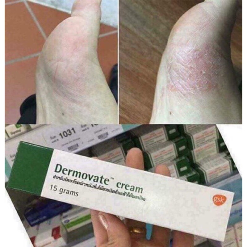 Kem DEMOVATE trị vẩy nến