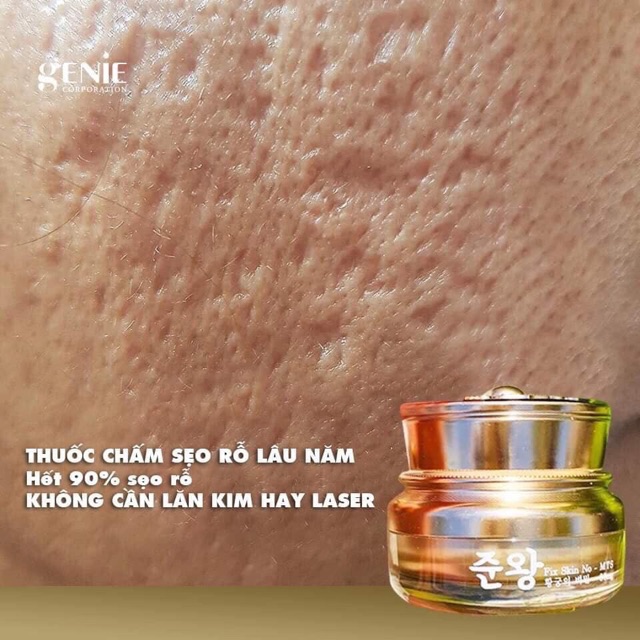 Kem xóa sẹo rỗ Non Fix Skin Genie.