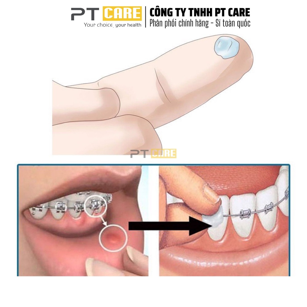 PT CARE | 01 Hộp Sáp Nha Khoa 3M Unitek Mỹ Cho Người Niềng Răng Chỉnh Nha Đau Mắc Cài Viêm Nướu