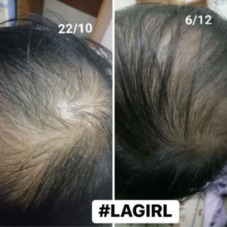 ♥️[Tặng Quà] LaGirl_Kích Thích Mọc Tóc♥️