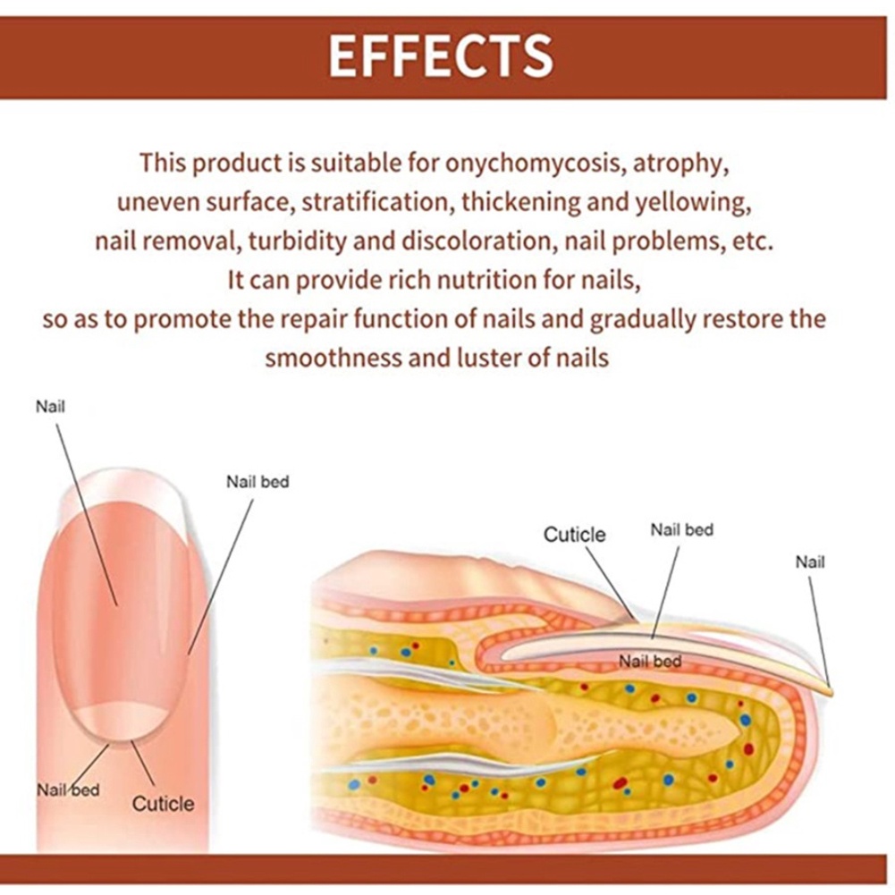 Ibealee Kháng Khuẩn Đặc Biệt Chất Lỏng Cho Onychomycosis Loại Bỏ Móng Kem Làm Dày Mềm Mại Móng Onychomycosis Okase
