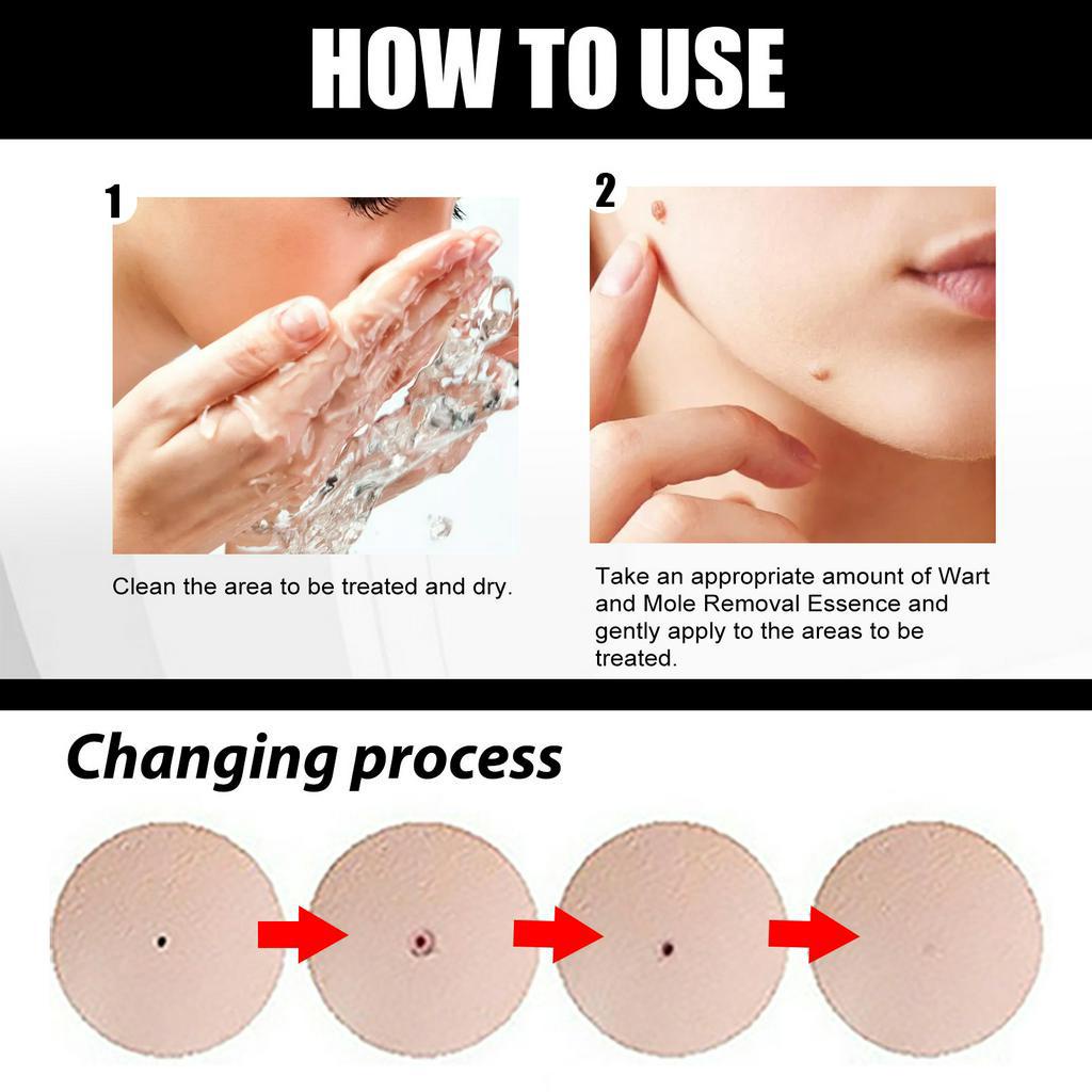 (Xài là hết) ACLIVE SKIN serum tẩy nốt ruồi hiệu quả rõ rệt đối với mụn thịt, mụn cóc, nốt ruồi, tàn nhang v.v...
