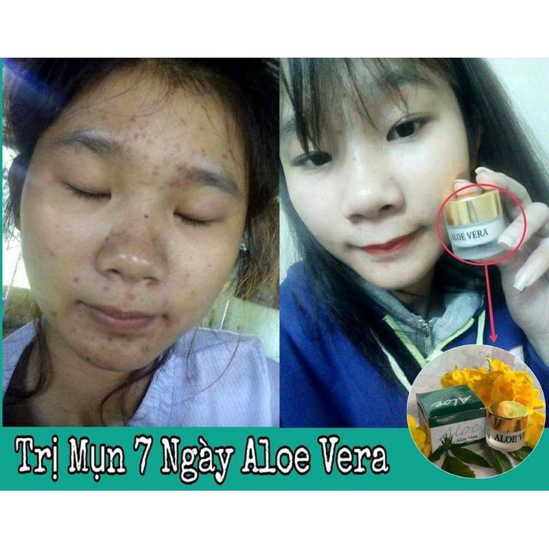 Kem mụn Aloe Vera sạch mụn đầu đen,mụn bọc,mụn trứng cá, sạch thâm, phục hồi da sau mụn | BigBuy360 - bigbuy360.vn