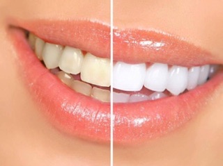 Bút tẩy trắng răng Dazzling  White