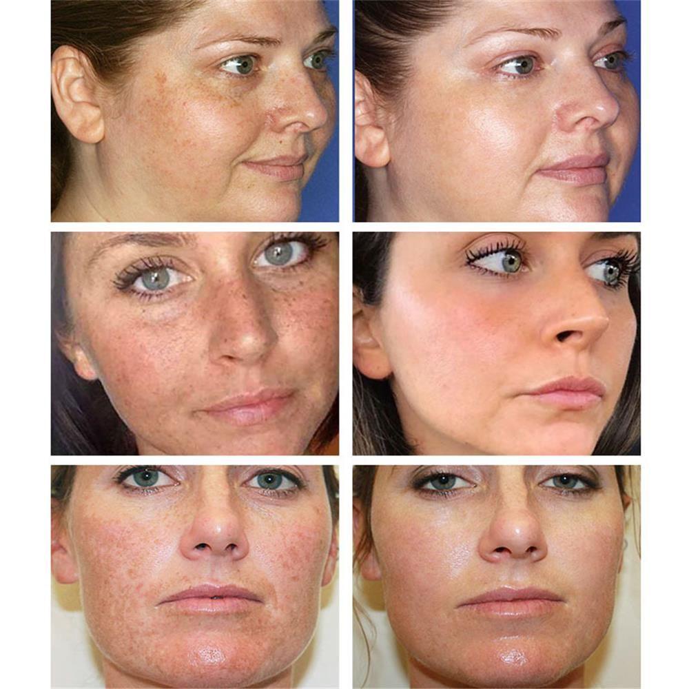 Kem Làm Trắng Da Mặt Loại Bỏ Melanin Dưỡng Ẩm Hiệu Quả