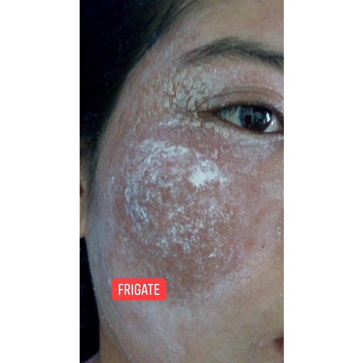 Keo Bạc FRIGATE Colloidal Silver - dành cho da mụn, da nhạy cảm, nh.iễ.m kem tr.ộ.n, demodex 30ml