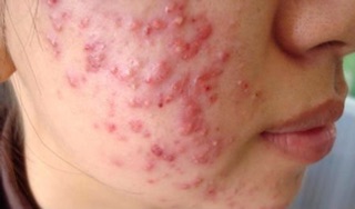 Kem bôi mụn trứng cá Pair