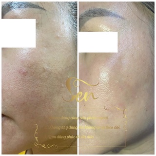 (COMBO GIÁ SỈ) TINH CHẤT - NẠ - SEN VIP - SERUM