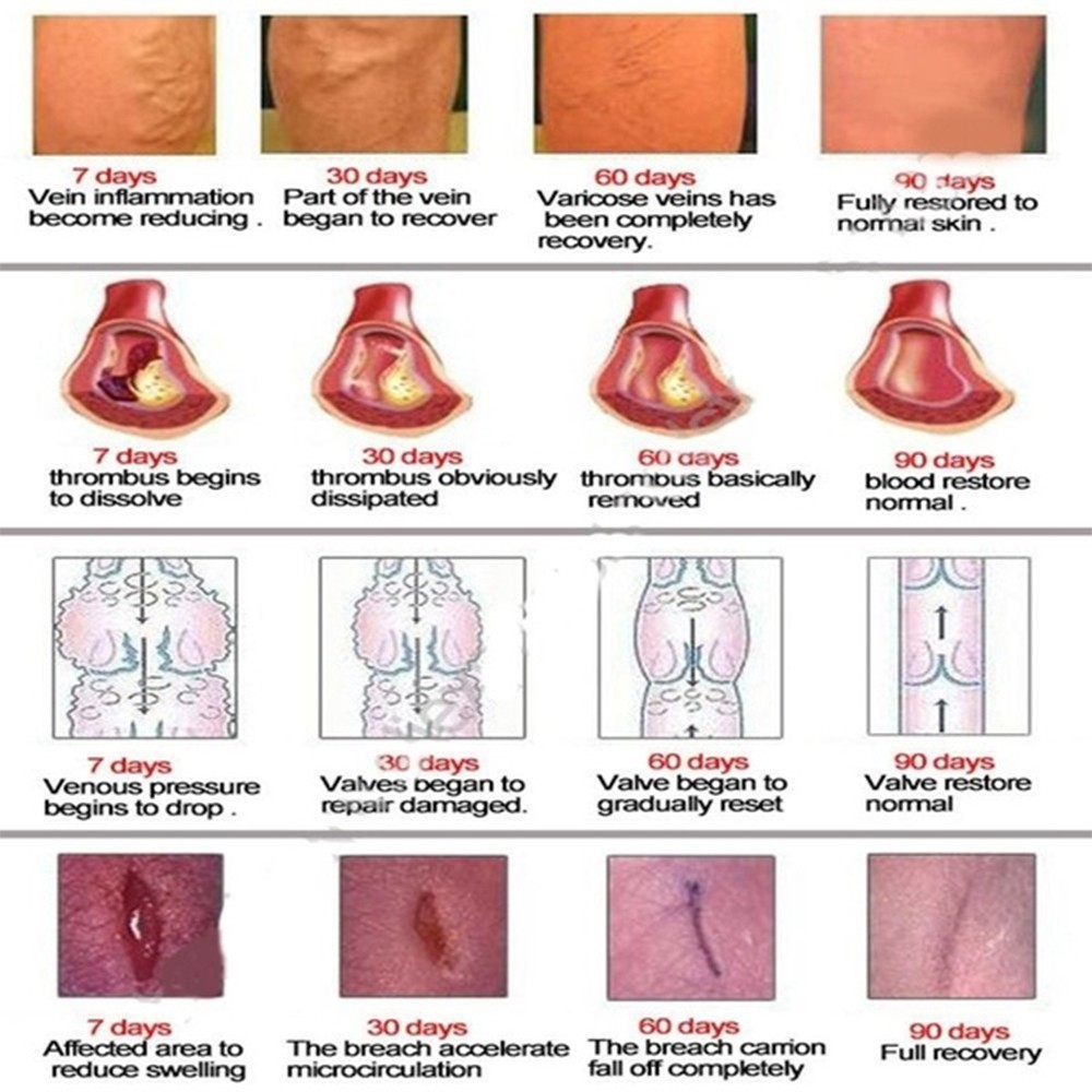 (Hàng Mới Về) Thuốc Mỡ Trị Giãn Tĩnh Mạch Tinh Chất Thảo Dược Trung Quốc Hiệu Quả