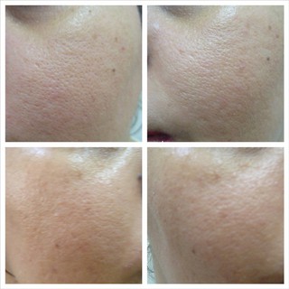 Serum thu nhỏ lỗ chân lông Pore
