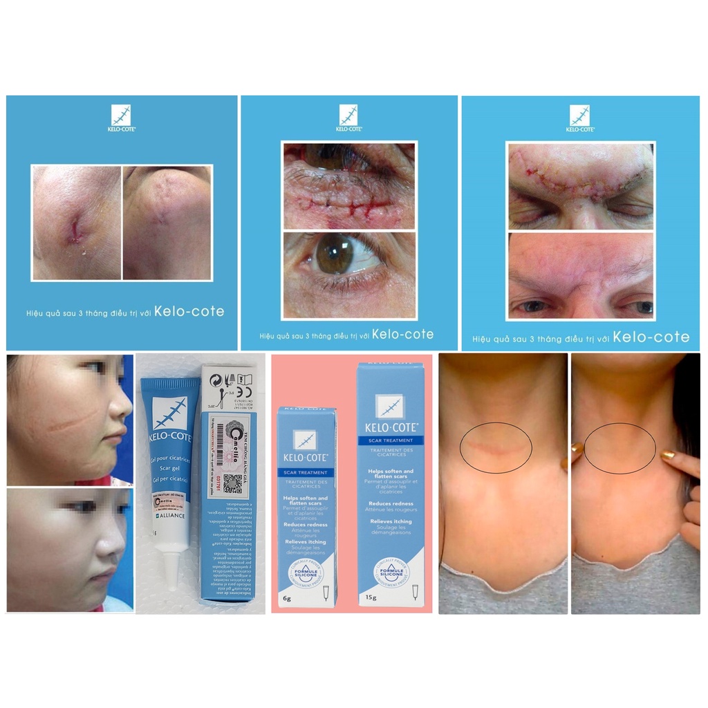 KELO-COTE Gel - Kem Ngừa Sẹo Lồi, Sẹo Lõm, Sẹo Phẫu Thuật, Sẹo Lâu Năm