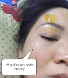 Chấm tàn nhang 7 ngày bong