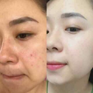 bộ đôi trị mụn và thâm đồng giá nhau