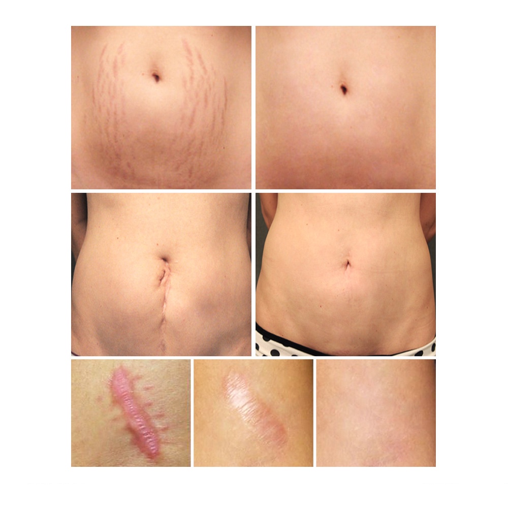 Có Hàng Breylee Gel Xóa Sẹo 30G Điều Trị Sẹo Mụn Xóa Vết Rạn Da Làm Trắng Thanh Toán Khi Nhận Hàng
