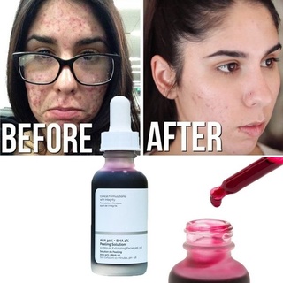 [Ordinary] Tẩy Da Chết The Ordinary AHA 30% + BHA 2% Peeling