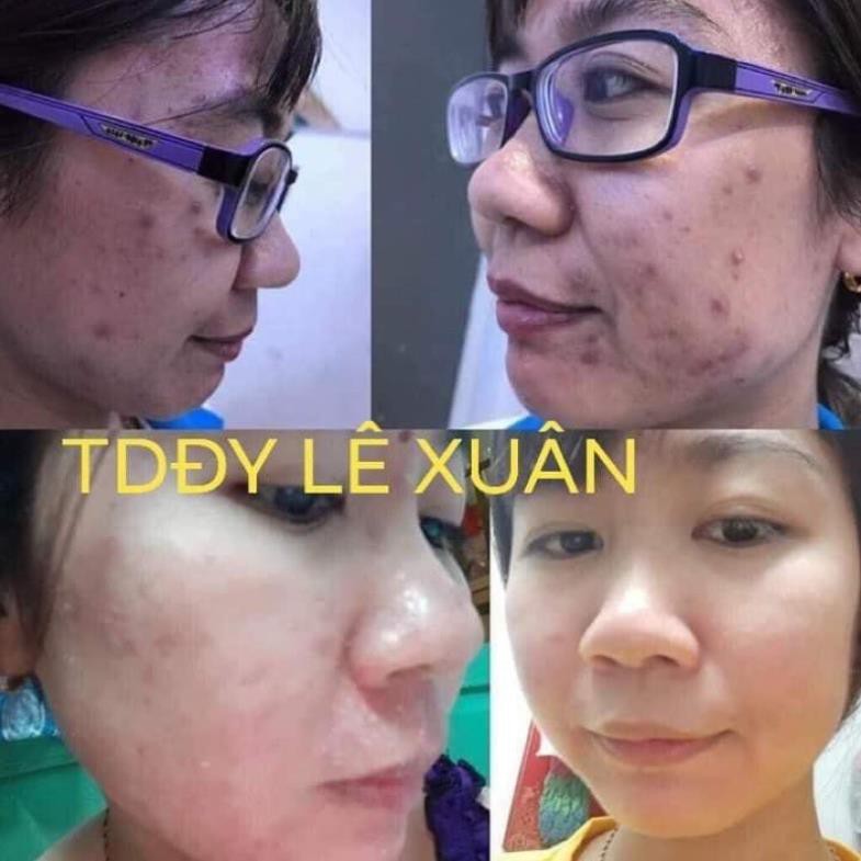 Tinh chất mụn Lê Xuân handmade 130ml | BigBuy360 - bigbuy360.vn