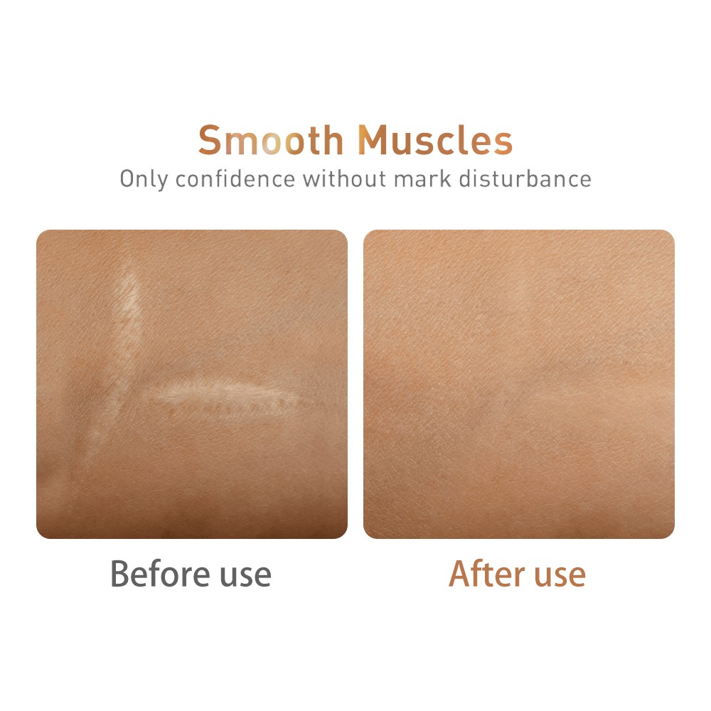 Serum Hỗ Trợ Giảm sẹo mụn và xóa vết rạn da thương hiệu LANBENA