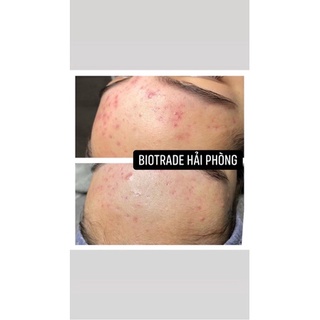 Dung Dịch Chấm Mụn-ACTIVE LOTION BIOTRADE ACNAUT 10ml