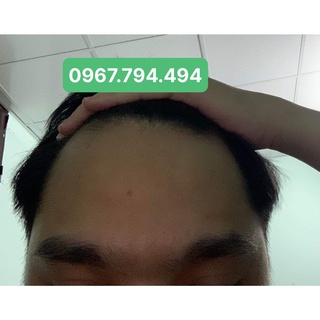 Thuốc mọc tóc Morr F5 ( MINOXIDIL 5% và 0.1% FINAS )