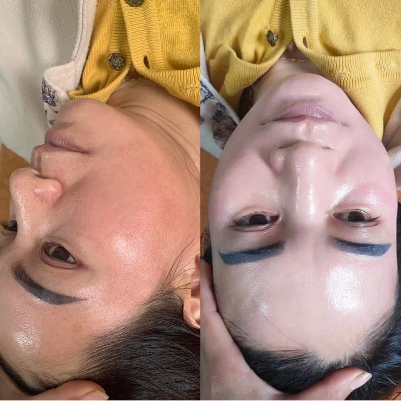 CẤY TRẮNG - dưỡng da , trẻ hoá da, bật tone 3-5 tone