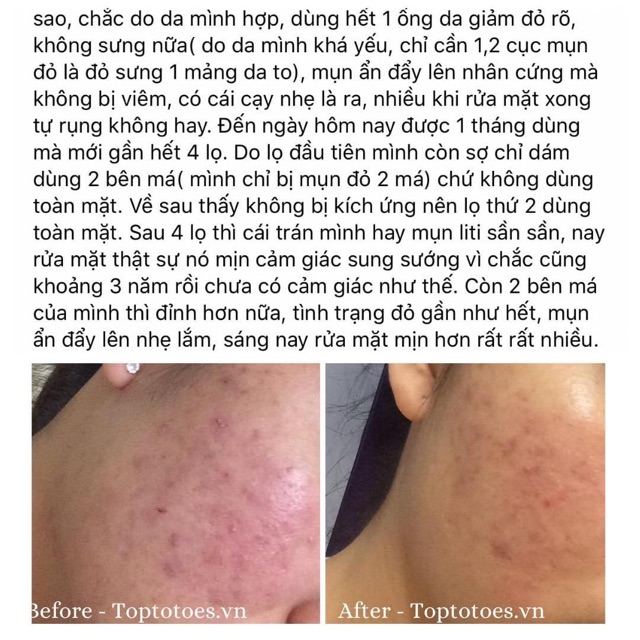 SERUM GIẢM MỤN TEANA NO PROBLEM SUPER PEPTIDES INTENSIVE CARE | Thế Giới Skin Care