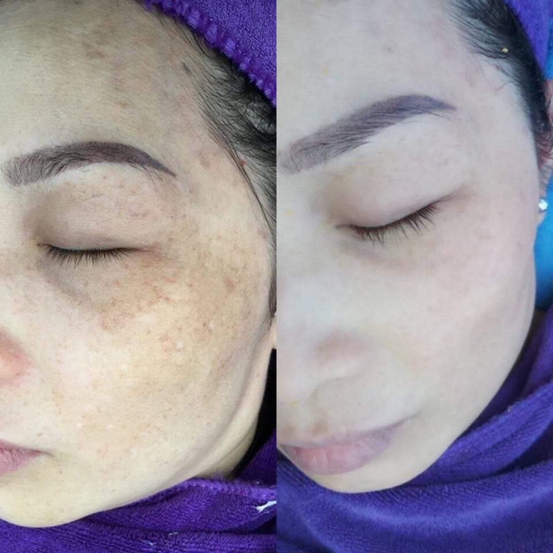 Kem dưỡng trắng mờ nám Royal