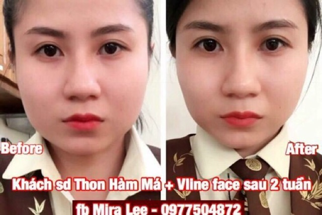 Tinh Chất Thu Xương Vline Face Hàn Quốc