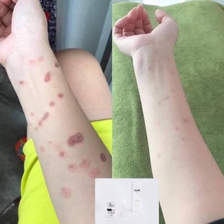 Trị thâm JIUHE cực đỉnh