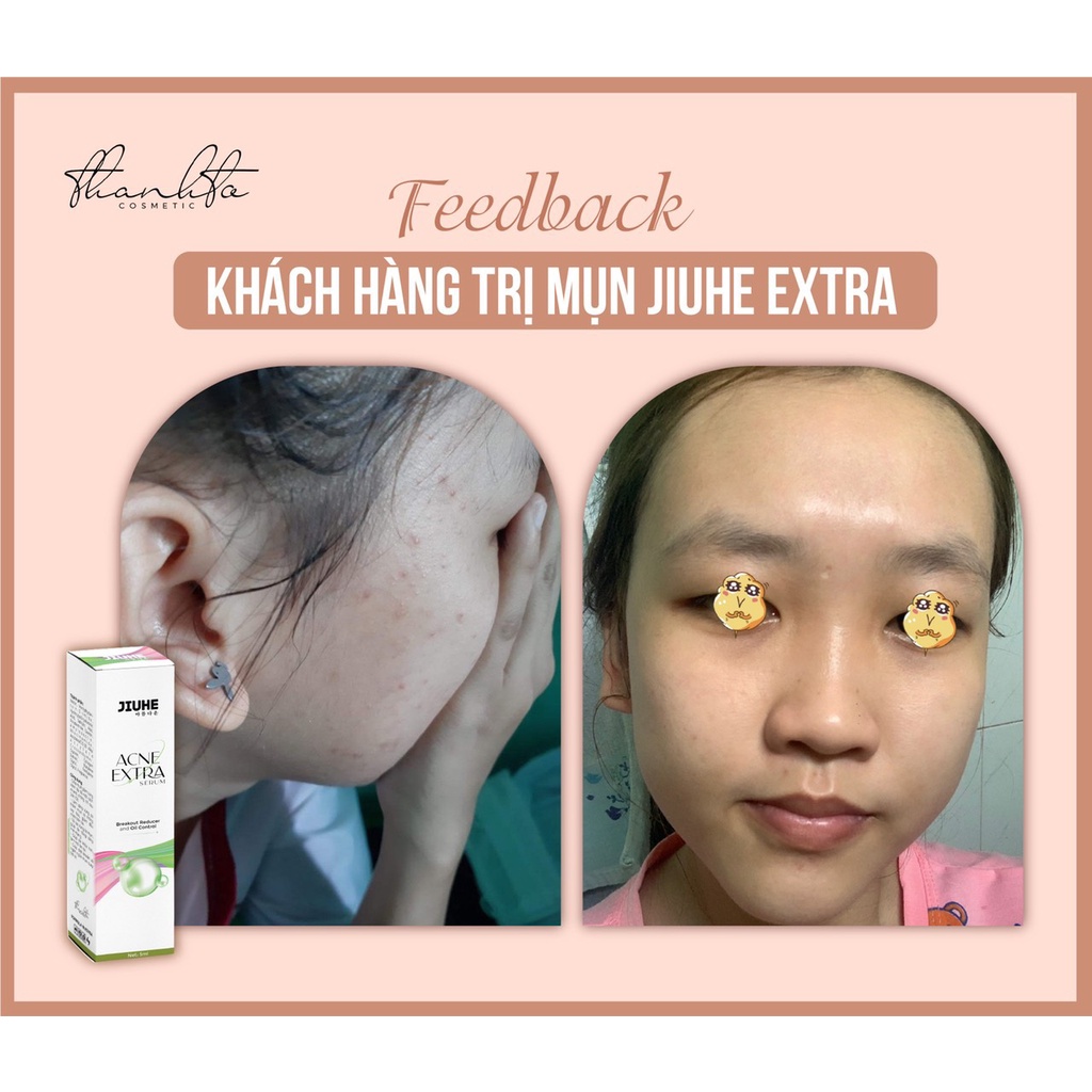 Serum Mụn Jiuhe Thanh Tô Acne Extra chính hãng Thanh Tô - Làm sáng vùng da thâm mụn và giảm dầu nhờn