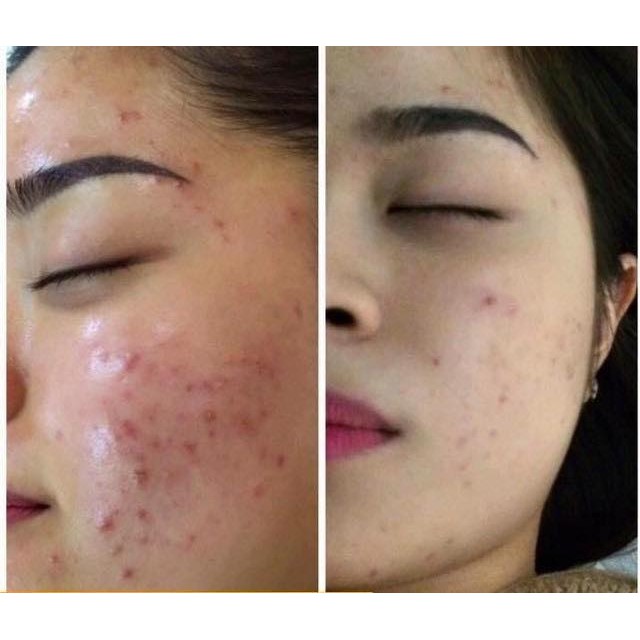 Serum làm dịu da kiểm soát nhờn dành cho da dầu, da mụn Image Skincare CLEARCELL Restoring Serum oil - Free 28g