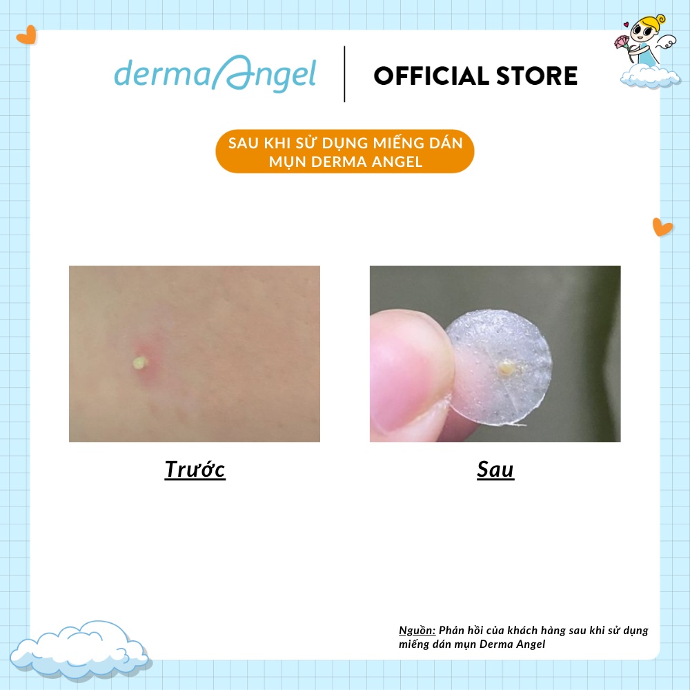 Sữa rửa mặt nhẹ dịu cho da dầu mụn và nhạy cảm Derma Angel