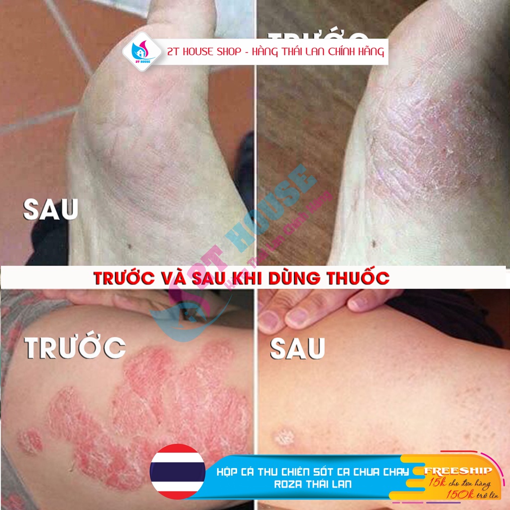 Kem Bôi Vảy Nến Der Mo Vate Cream Thái Lan, Kem Bôi Giảm Vảy Nến Chính Hãng Tuýp 15g, 2T House Hàng Thái Lan Chính Hãng