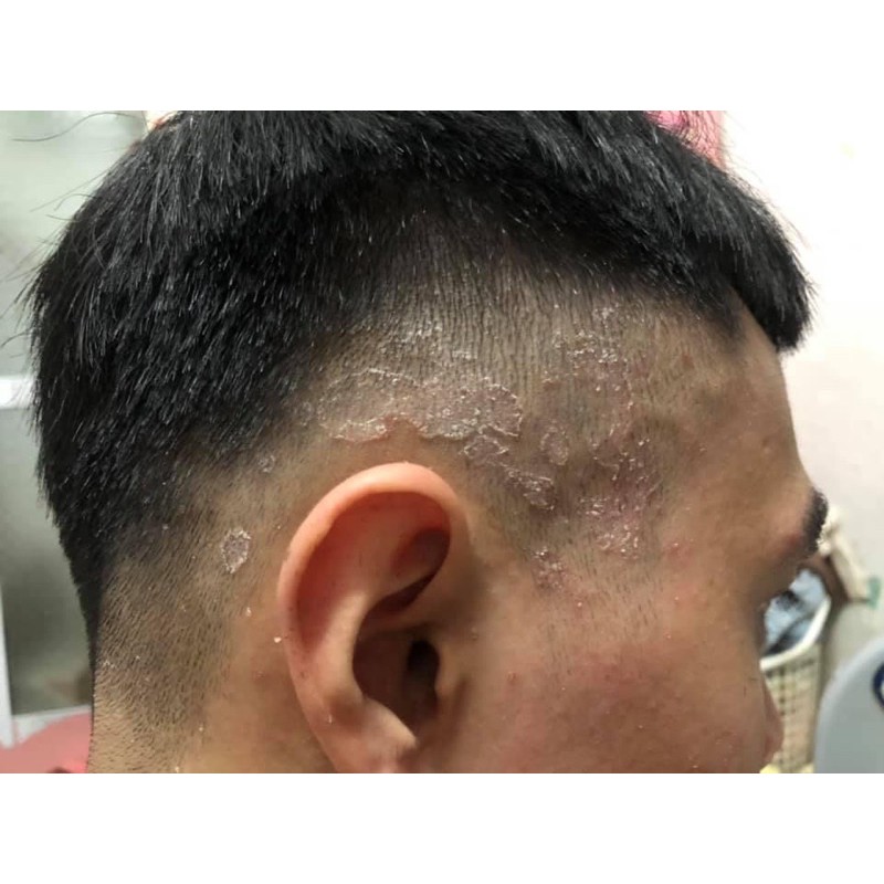 |Hộp Đỏ| Kem bôi da bệnh Vẩy nến, Nấm ngứa, á sừng, Hắc lào. |PKTrungBinh