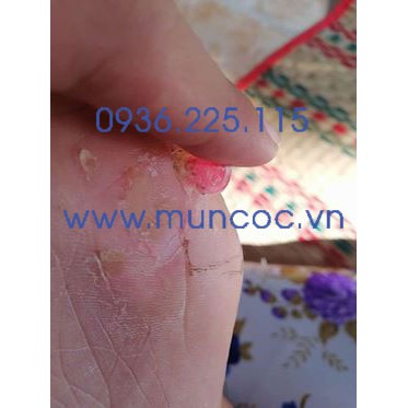 [CHÍNH HÃNG] Miếng dán mụn cóc, mắt cá chân Plasters hộp 18 miếng