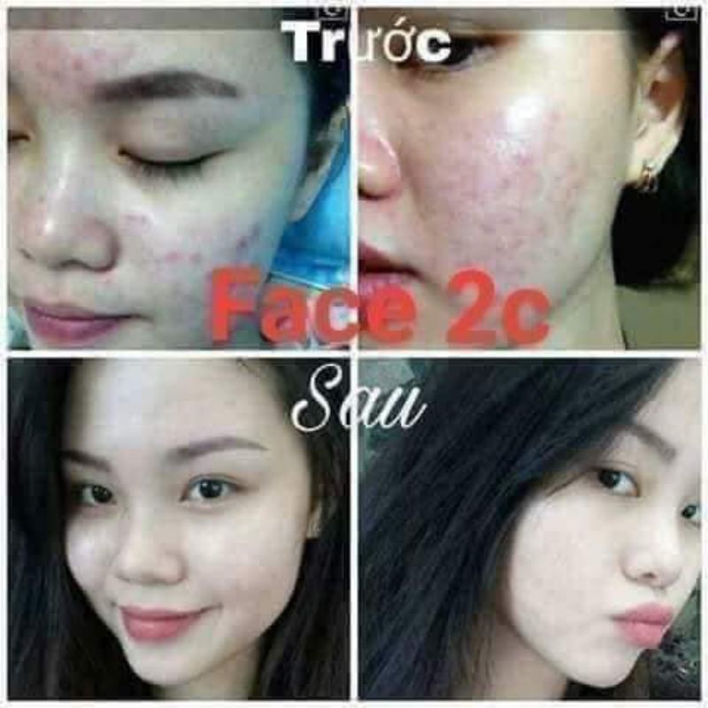 FACE MỤN 2C(mua 10tặng 1)