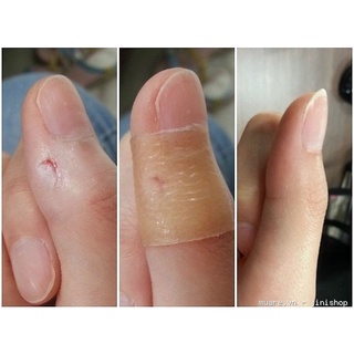 10 Miếng Dán Mụn DuoDerm