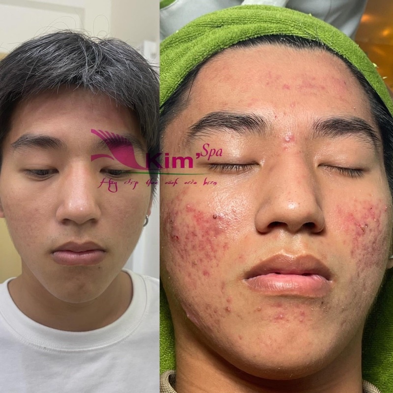 Kem Tái Tạo Da Đông Y Cao Cấp Kim Spa Mụn Nám Tàn Nhang