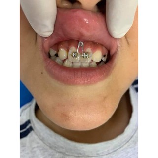 Loop đóng khoảng răng cửa bẻ trên dây TMA của mỹ