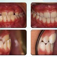 (A1+A2) Dụng cụ niềng răng cho trẻ em