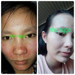 Trị mụn Như Ngọc