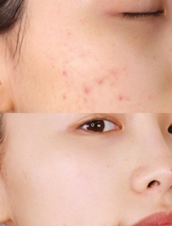 TINH DẦU TRÀM TRÀ CHẤM MỤN A’PIEU NONCO TEA TREE OIL