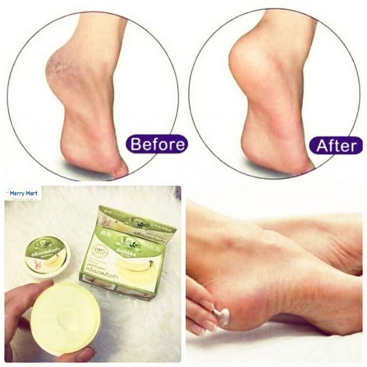 [chuẩn thái] Kem Nứt gót Chân Banana giảm ngay tình trạng nứt gót chân nam nữ