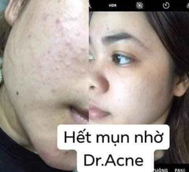 CHẤM MỤN DR. ACNE